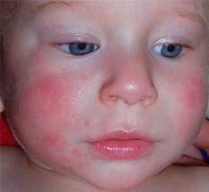 аллергия на лице фото