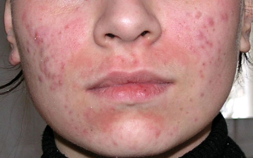 фото аллергии на коже