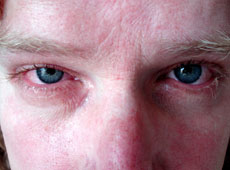 аллергия на очах фото