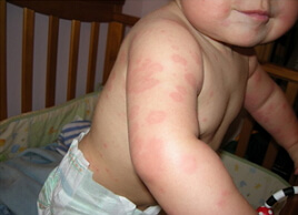 аллергия на теле фото