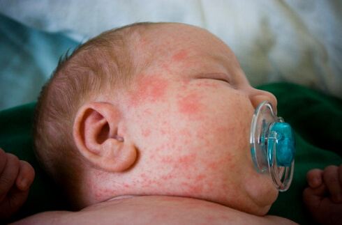 фото аллергии у новорожденных