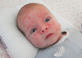 аллергия у грудного ребеночка фото