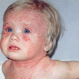 аллергический дерматит у деток фото