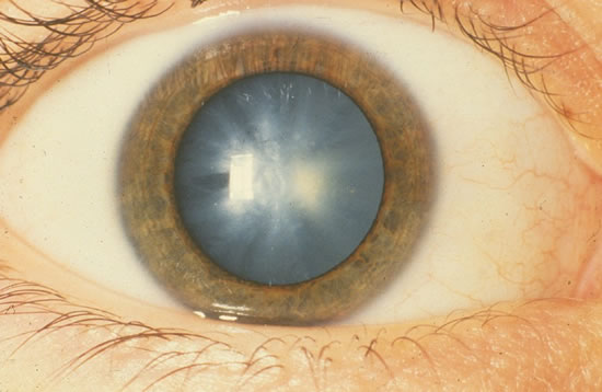начальная катаракта