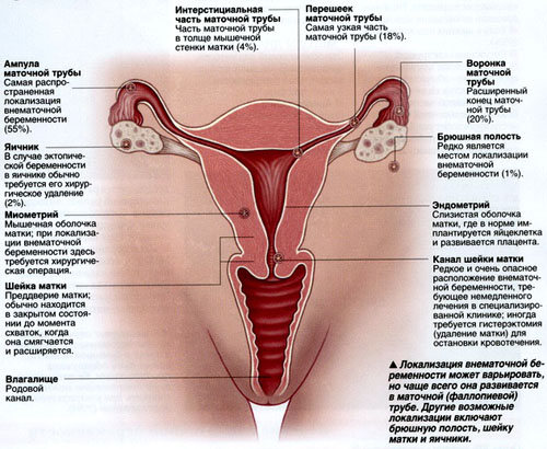 внематочная беременность фото2