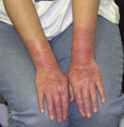 аллергия на латекс фото