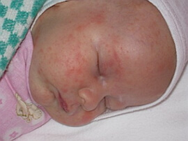 аллергия у новорожденного фото