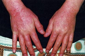 аллергический дерматит фото