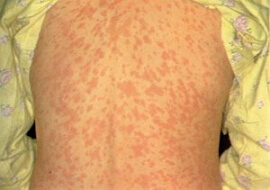 аллергия на коже у ребеночка фото
