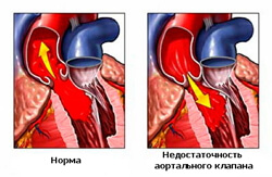 дефицитность аортального клапана фото