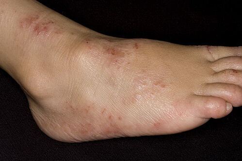 фото дерматита на ногах