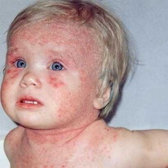 атопический дерматит у малышей фото