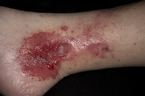 фото контактного дерматита на ногах