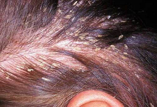 фото на голове себорейного дерматита